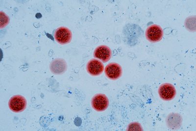 Microscopic view of Cyclospora cayetanensis oocysts under magnification, stained bright red. cyclosporiasis outbreak, foodborne parasites, intestinal infections. water pollution, concept idea