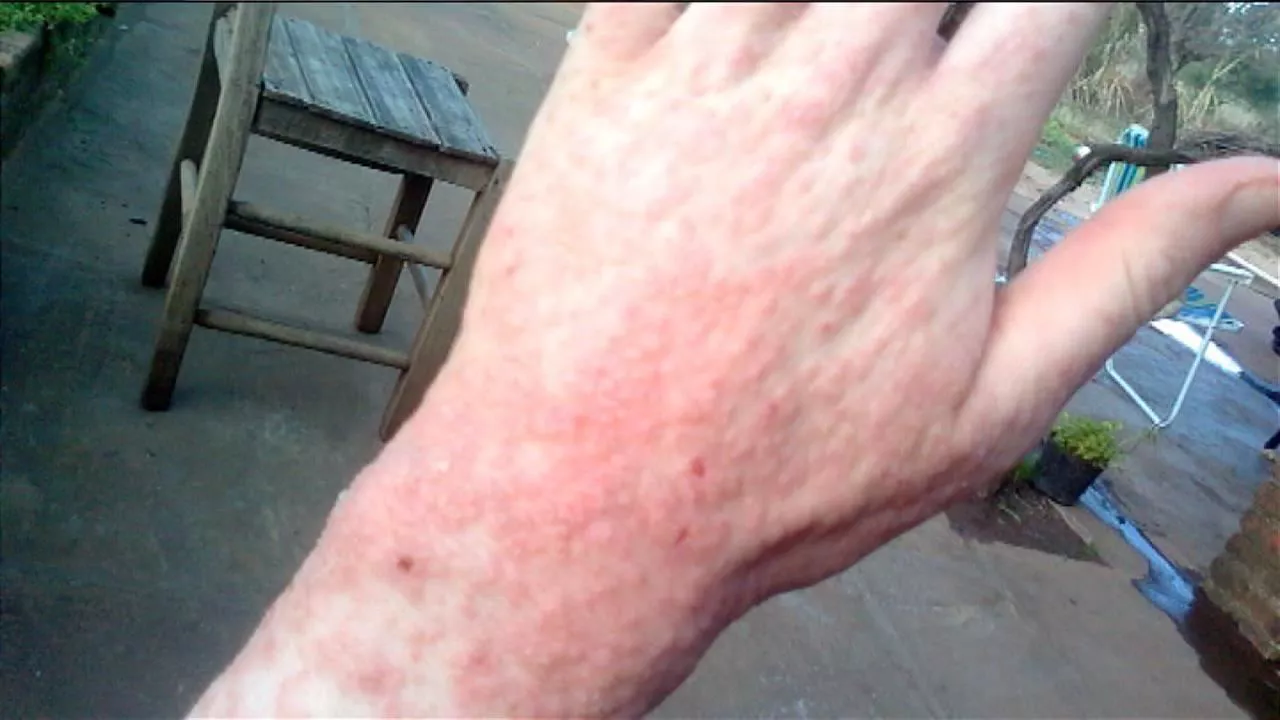 Una mano con sarna