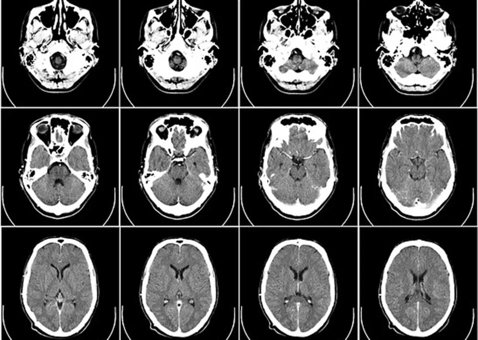 cerebro garuna alzheimer tomografia