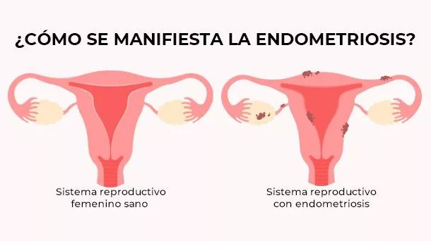 ¿Cómo se manifiesta la endometriosis?