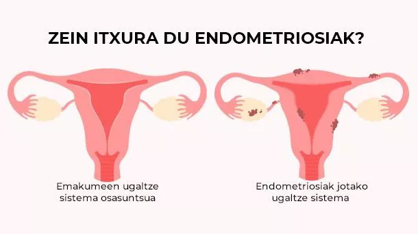 Zein itxura du endometrisosiak?