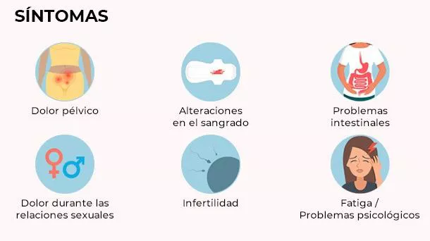 ¿Cuáles son los síntomas de la endometriosis?