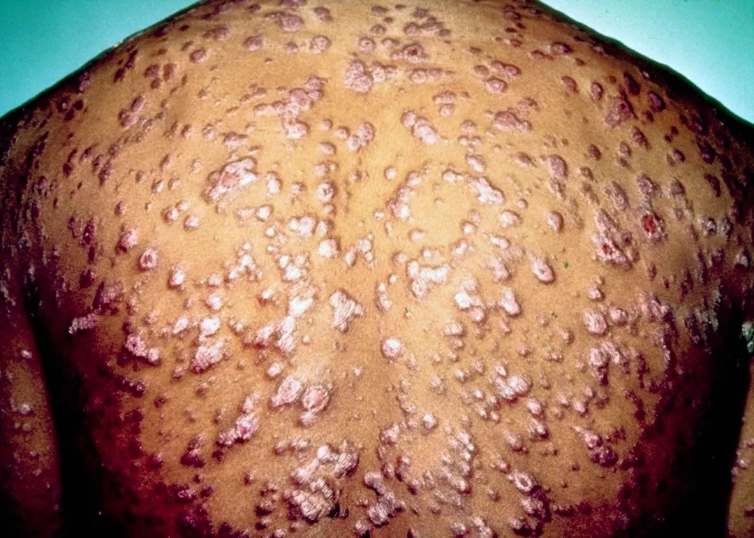 Syphilis_second_state_wikimedia-commons