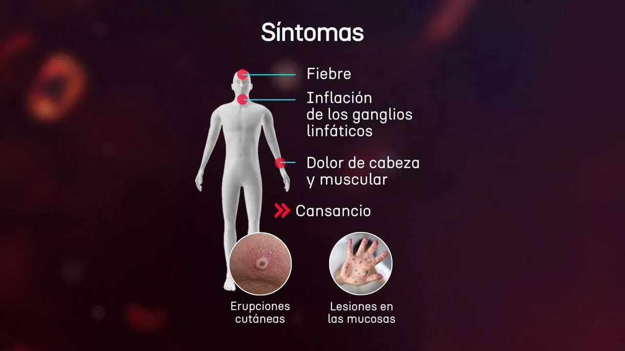 Sintomas viruela mono cast