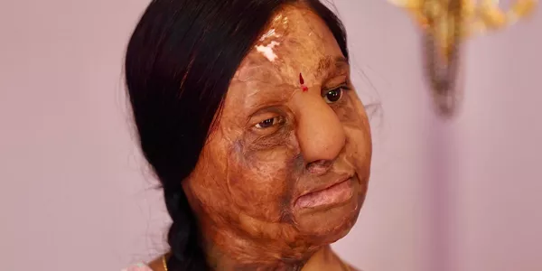 8M Bangalore, India. Ratna, de 31 años, fue rociada con ácido. . EFE. 