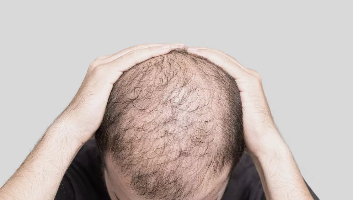 alopecia burusoiltasun
