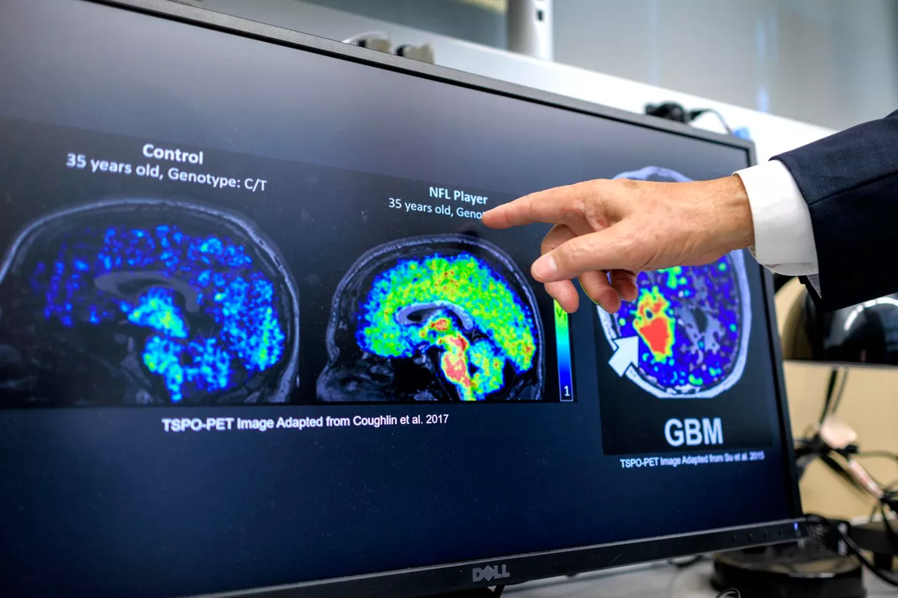 MIAMI (United States), 17/09/2025.- Dean of Robert Stempel College of Public Health & Social Work at Florida International University Doctor Tomas R. Guilarte talks about the images of quantitative autoradiography displayed on a computer screen in his lab at Florida International University in Miami, Florida, USA, 17 September 2025. Florida International University is investigating Translocator Protein (TSPO), a biomarker of neuroinflammation, and its role in the progression of Alzheimer's disease. Early findings show that TSPO levels increase well before memory loss occurs, offering hope for early detection and improved treatments. EFE/EPA/CRISTOBAL HERRERA-ULASHKEVICH
