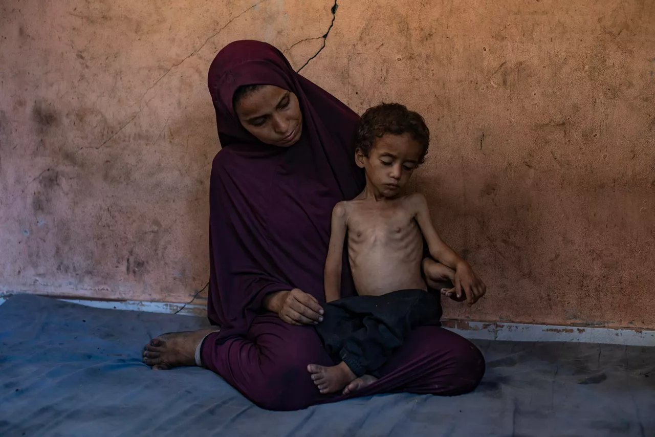 GAZA (---), 19/07/2025.- Palestinian child Yazan Abu Foul, aged two, is cared for by his mother Naima, as he suffers from severe malnutrition due to the acute shortage of food caused by the blockade imposed on the Gaza Strip and the closure of border crossings, in Al-Shati refugee camp, west of Gaza City, 19 July 2025. Yazan lives in harsh environmental and health conditions, with his family lacking the basic necessities of life amid a worsening humanitarian crisis. According to medical sources, the child’s health continues to deteriorate due to the lack of proper nutrition and necessary medical care. Humanitarian organizations have warned of an imminent food catastrophe threatening the lives of thousands of children in the besieged Gaza Strip, this situation coming at a time when Gaza’s residents face severe food insecurity and a sharp decline in health services, amid ongoing restrictions on the entry of humanitarian aid and essential supplies. EFE/EPA/HAITHAM IMAD
