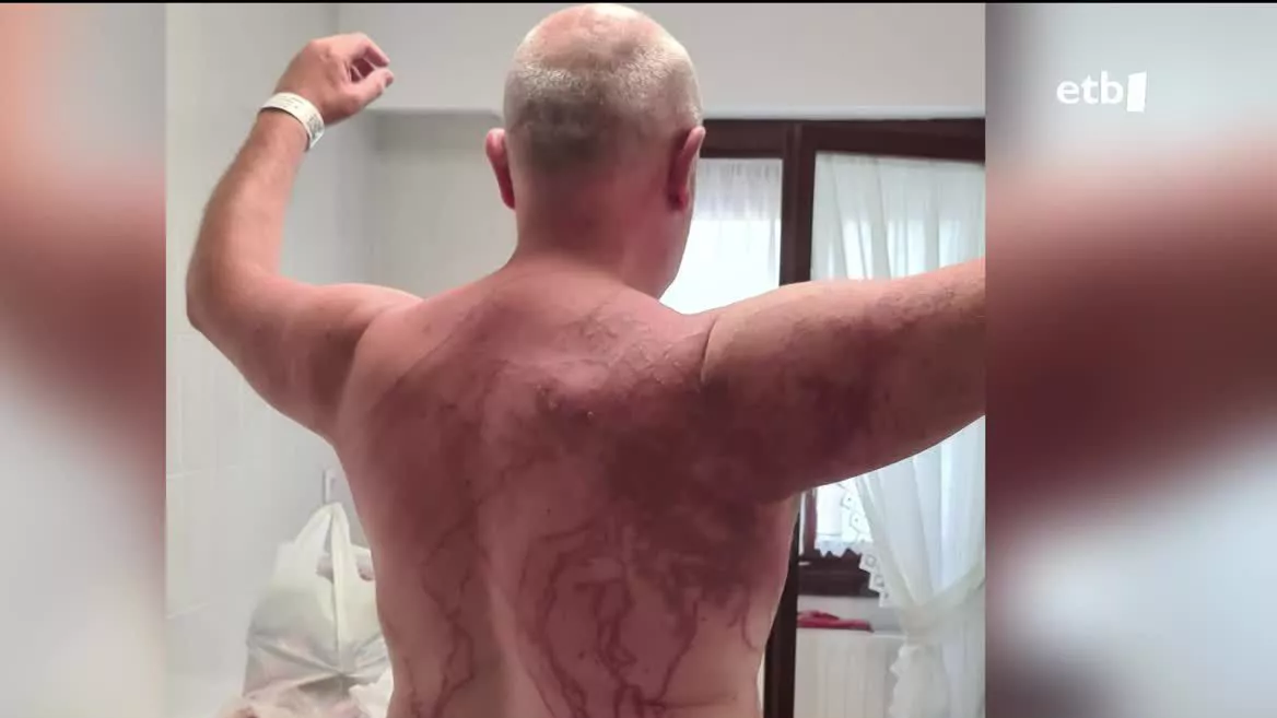 Donostiako Ospitaleko larrialdi zerbitzuetan sei kasu artatu dituzte uda honetan; horietako bi larriak. Javierren kasua horietako izan da eta jakitun da marka hauek betirako geldituko zaizkiola.
