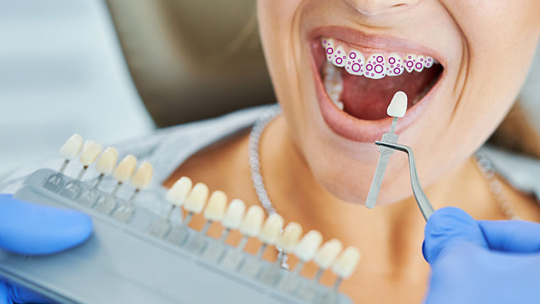 Tooth whitening using hydrogen peroxide