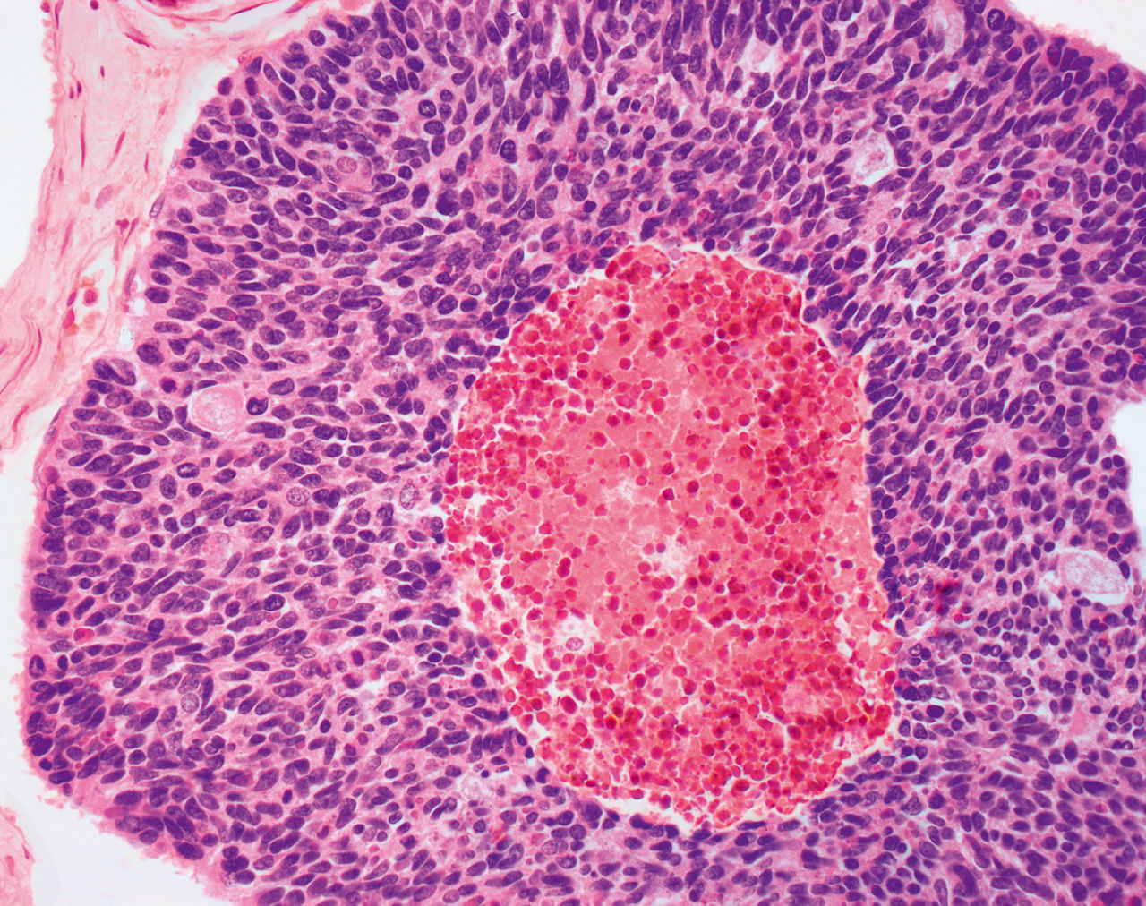 Light micrograph (LM) of a section through cancerous lung tissue showing a mixture of small and medium-sized cancer cells in a case of small cell carcinoma (SCC).