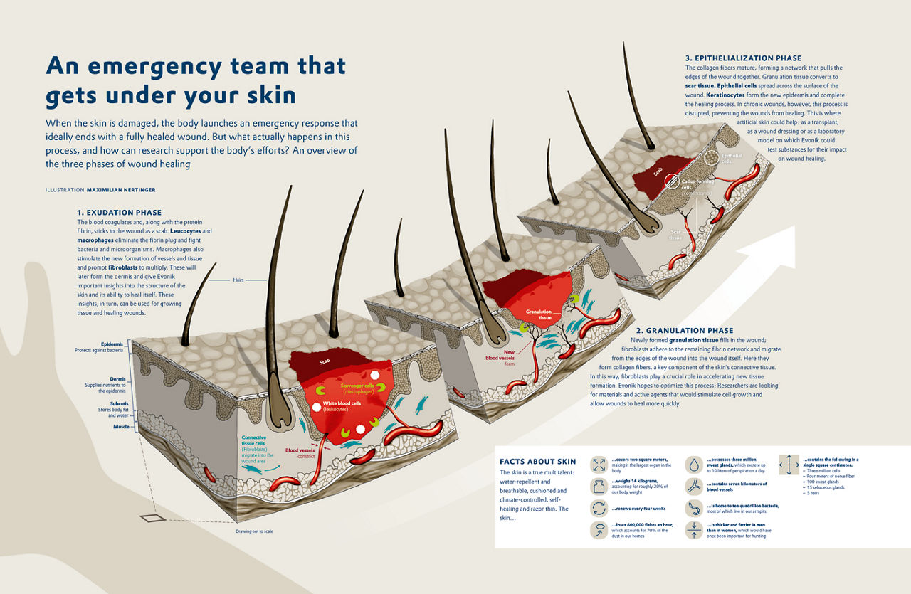 Infographic wound healing