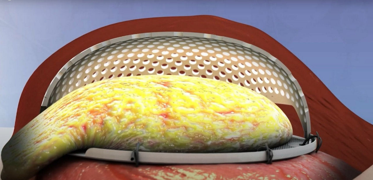 A graphic shows how new tissue grows within the implant.