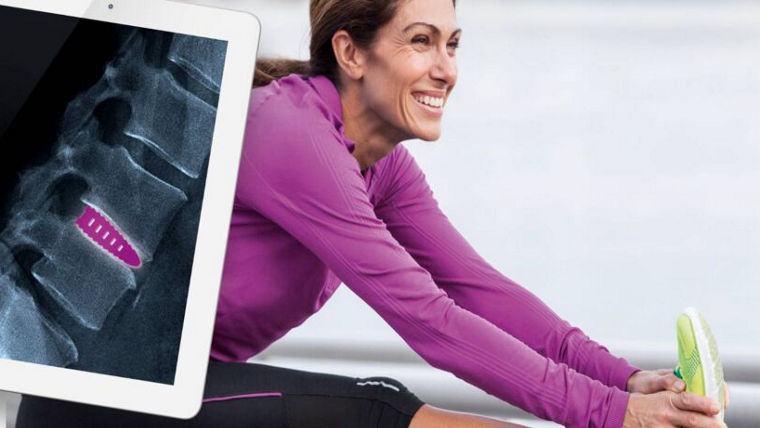 A smiling woman in purple sportswear stretching her leg while a tablet shows a spinal X-ray with a highlighted implant.