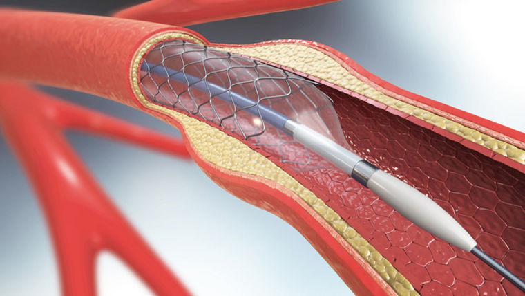 This image is a detailed medical illustration showing the placement of a stent within an artery. The artery is displayed in cross-section, highlighting internal structures such as the endothelium and plaque buildup. A balloon catheter is shown inflating to expand the stent against the arterial walls, facilitating improved blood flow. Additional arteries are visible in the background, providing anatomical context to the vascular procedure.