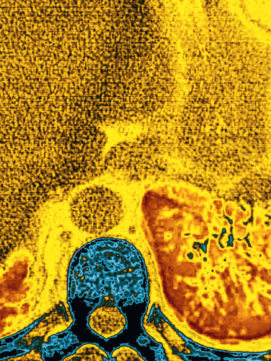 Cystic fibrosis CT scan 