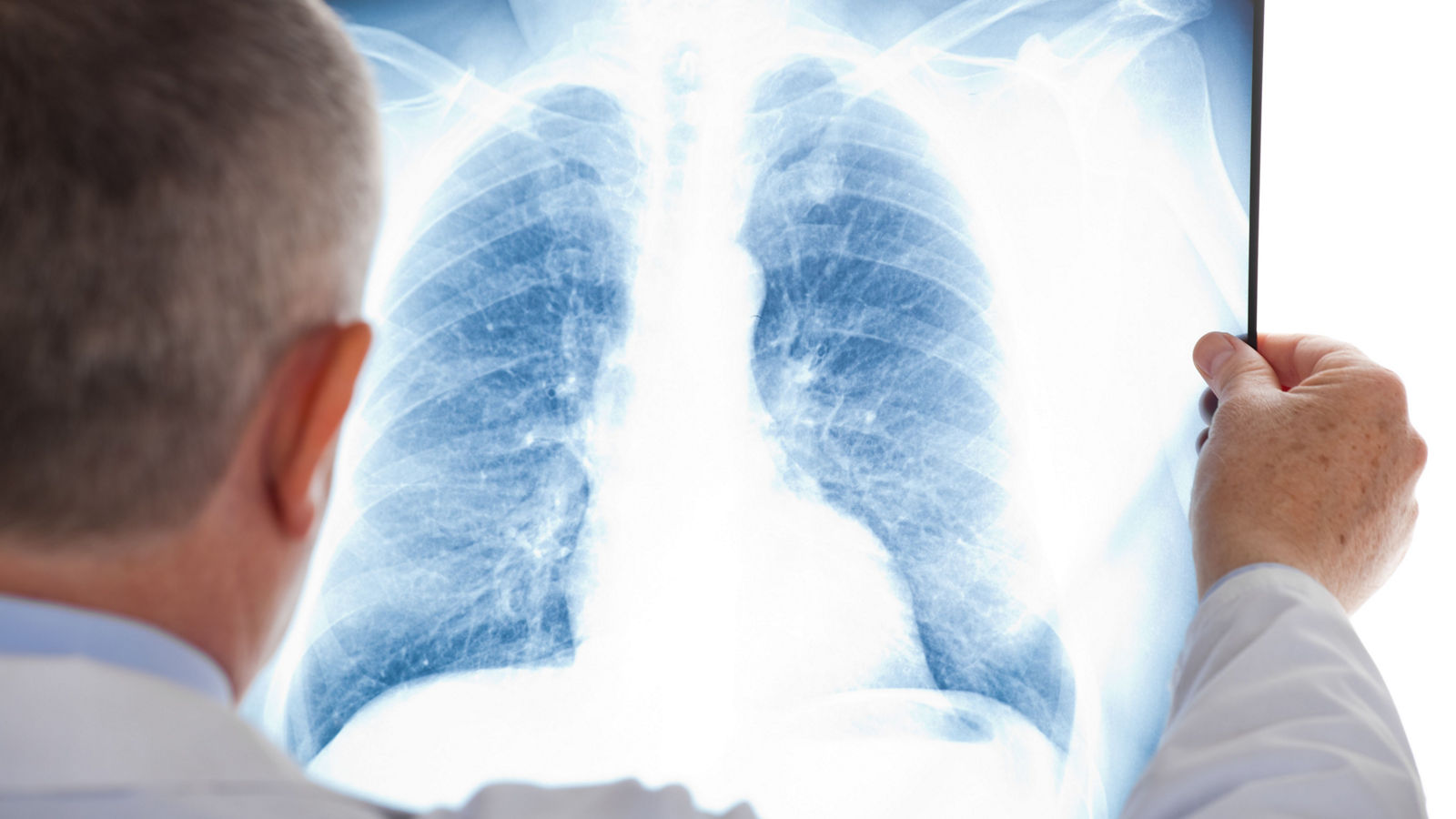 Doctor examining a lung radiography