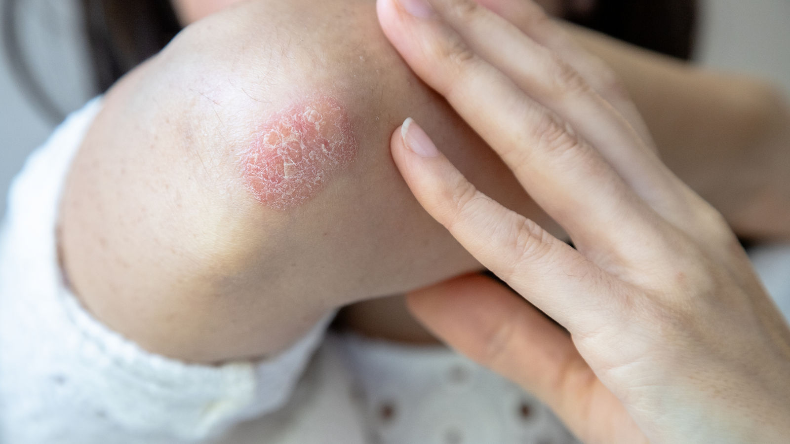 Frau mit Schuppenflechte am Ellbogen