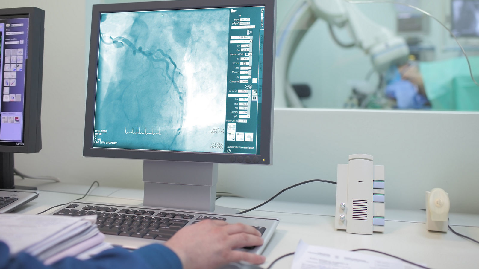 Visualization of the heart vessels (coronary vessels) on the monitor in the operating x-ray lab.,Visualization of the heart vessels (coronary vessels) on the mon