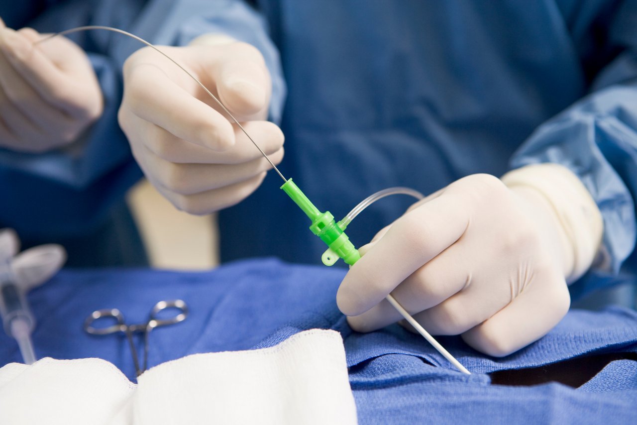 Vorhofflimmern: Trends der Katheterablation