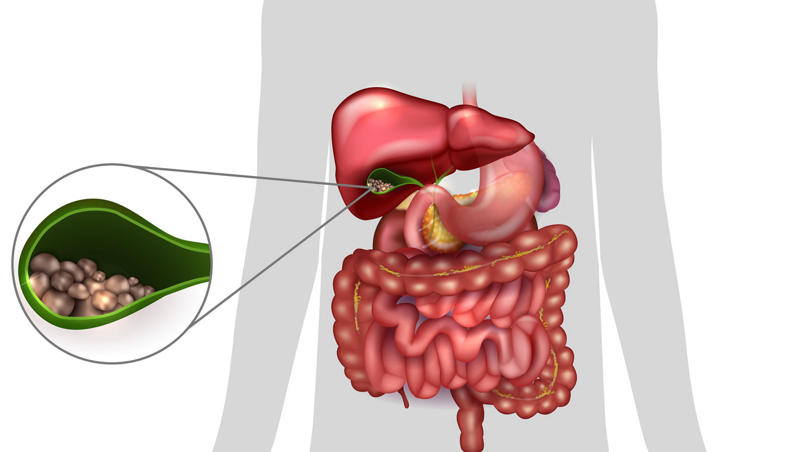Gallstones in the Gallbladder, human silhouette and anatomy of surrounding organs.
