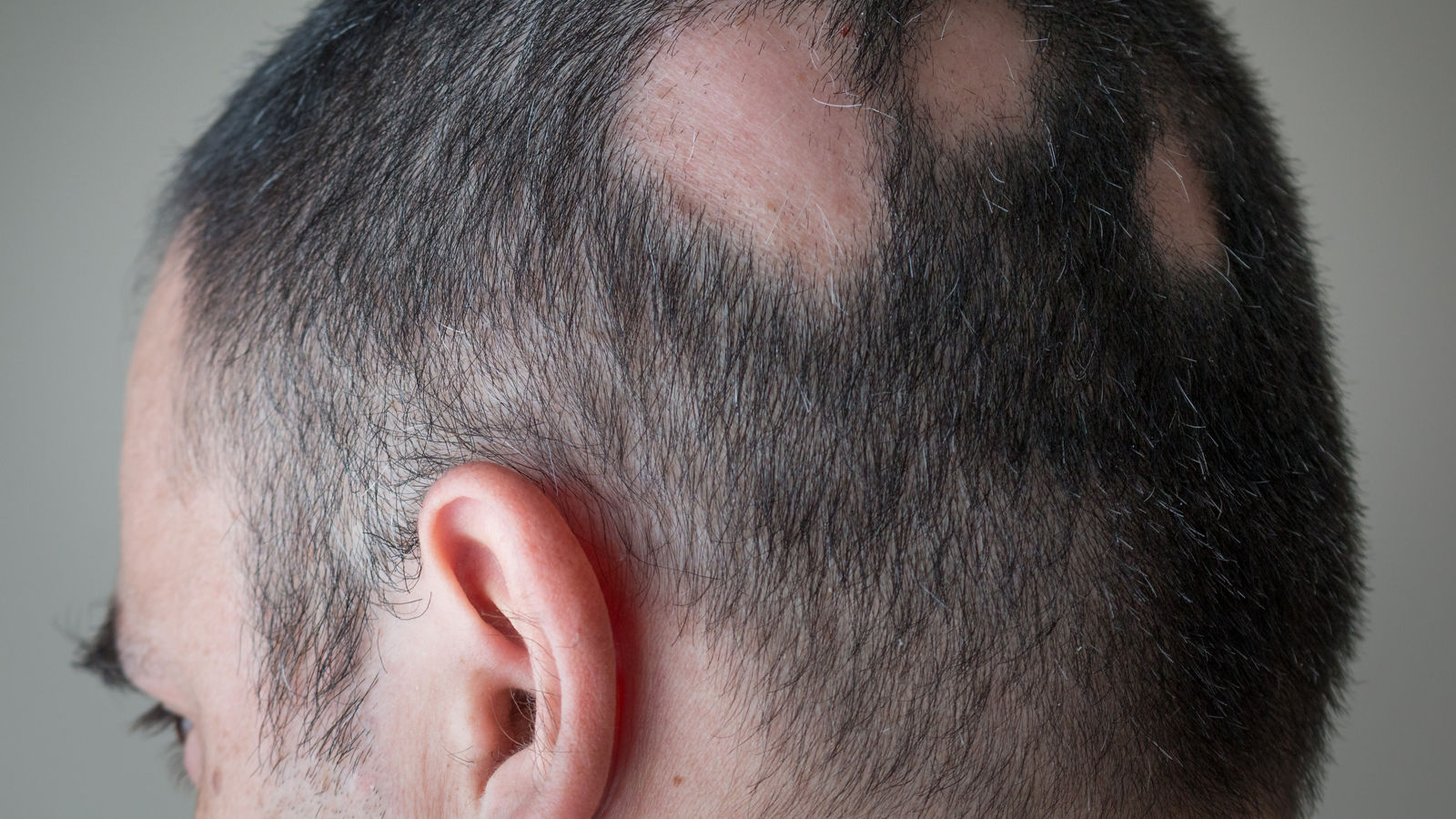 Alopecia Aerata - Spot Baldness