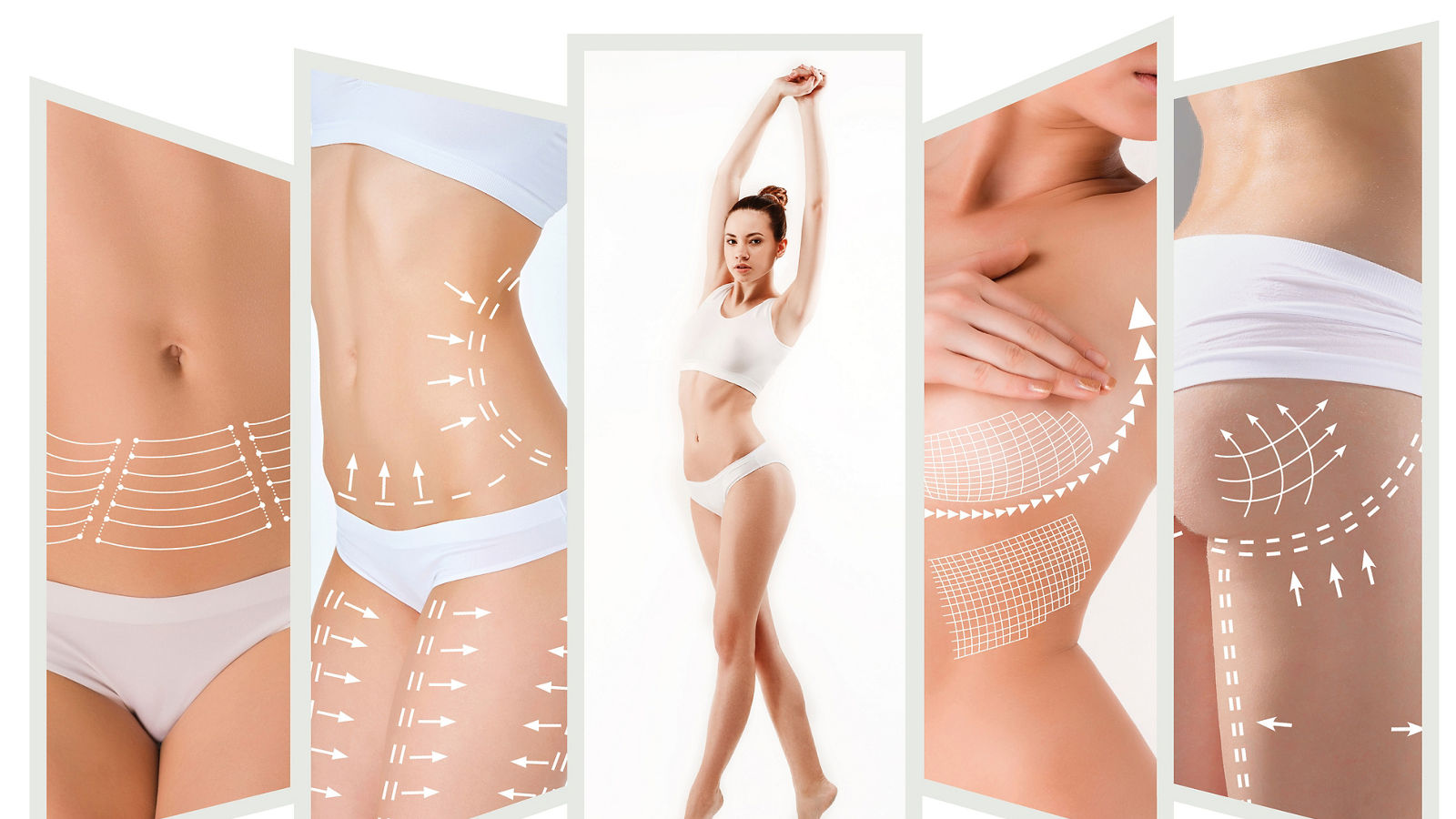The cellulite removal plan. White markings on young woman body preparing for plastic surgery. Concept of slimming, liposuction, strand lifting