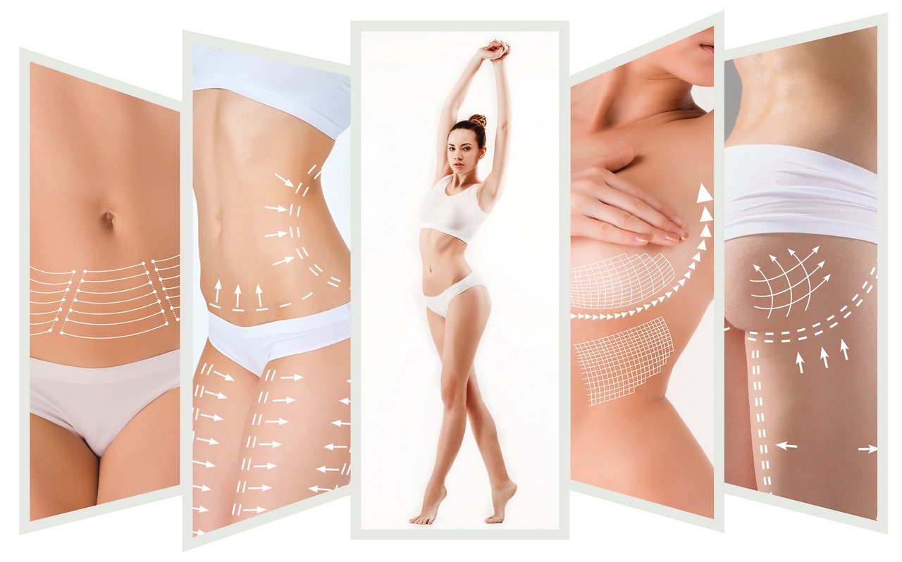 The cellulite removal plan. White markings on young woman body preparing for plastic surgery. Concept of slimming, liposuction, strand lifting