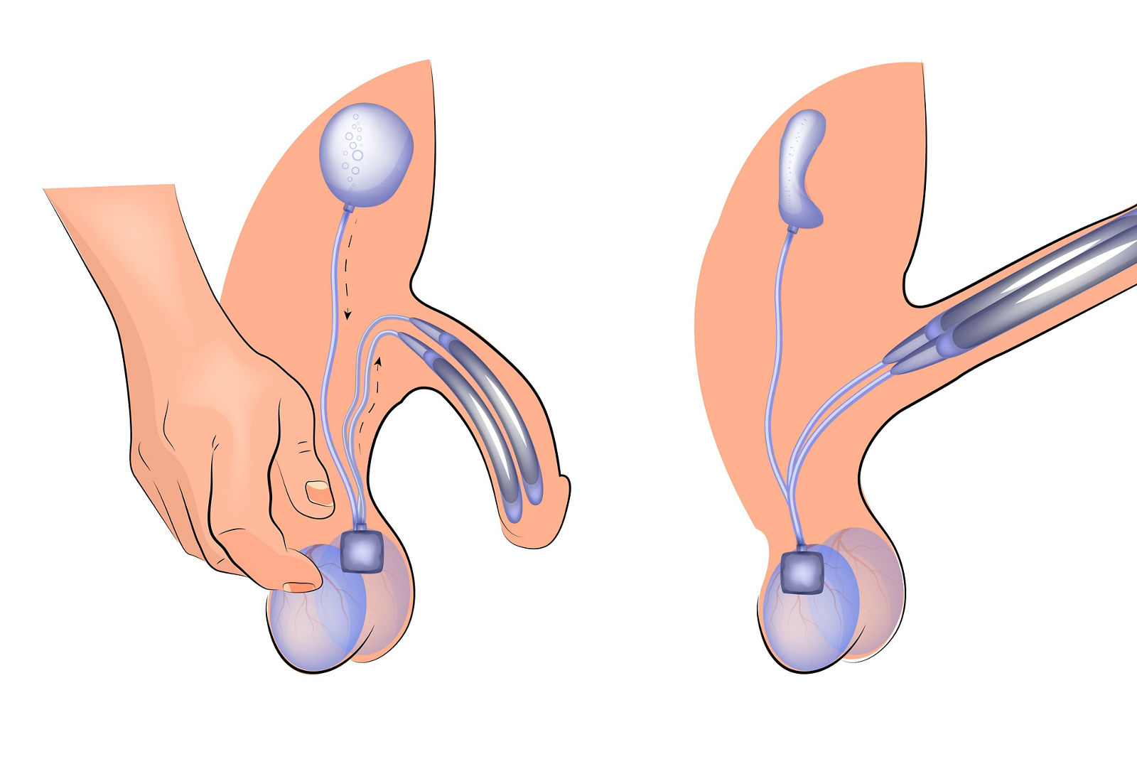 Schwellkörperprothese