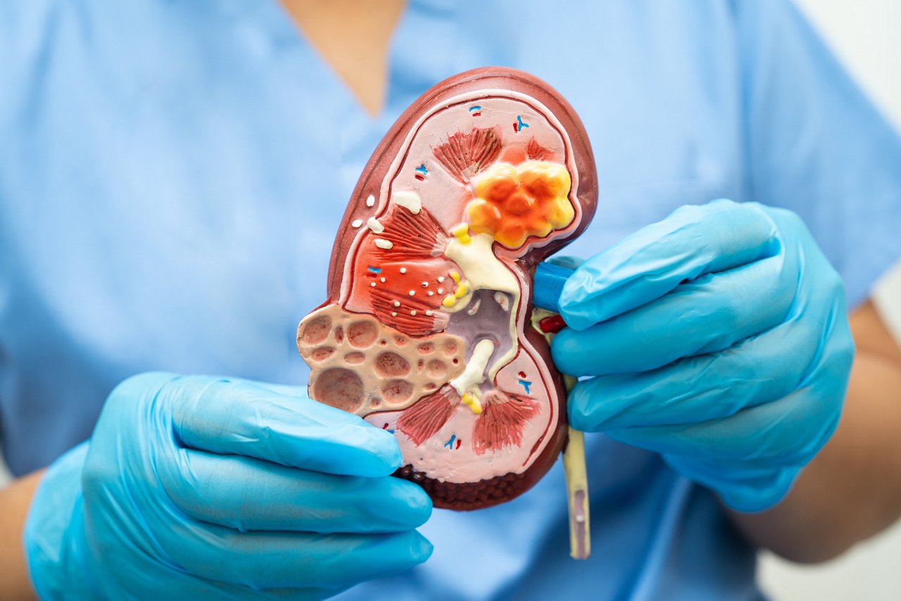  Chronische Nierenerkrankung, Arzt mit Modell des Harnsystems, Urologie, geschätzte glomeruläre Filtrationsrate (eGFR).