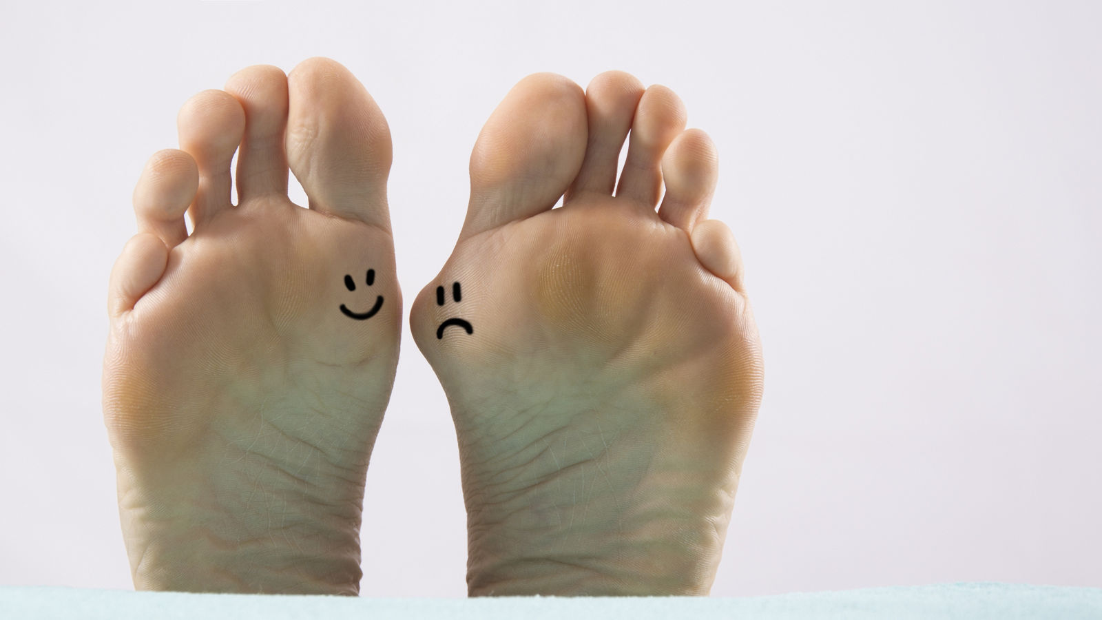 Hallux valgus, bunion in foot on white background