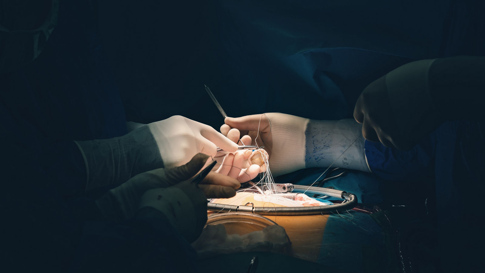Team of surgeons minimally invasive aortic valve surgery replacement with sutures placed of each commissure suspended. Sutures are placed through the annulus and through the aortic prosthesis and tied