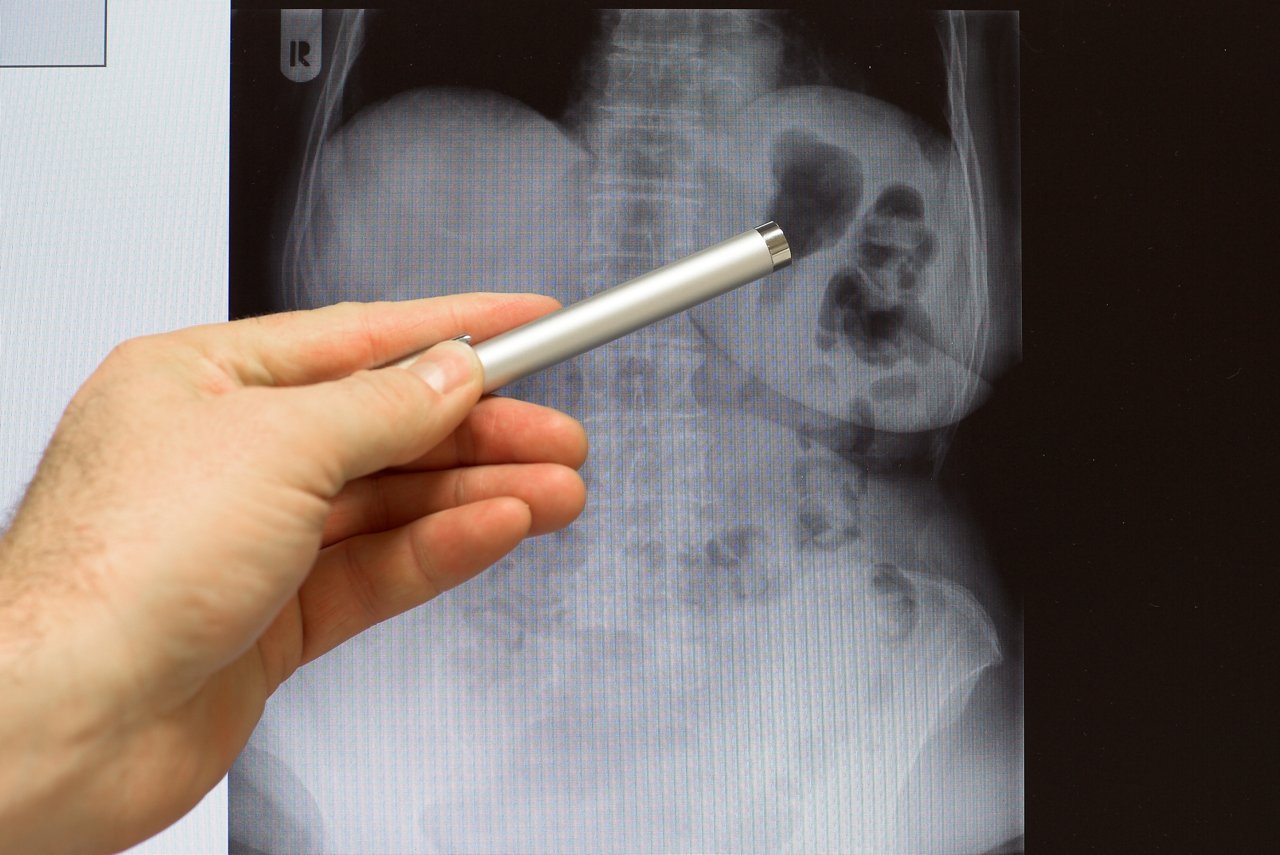 Arzt zeigt mit Hand und Kugelschreiber auf Röntgenbild des Bauchraumes