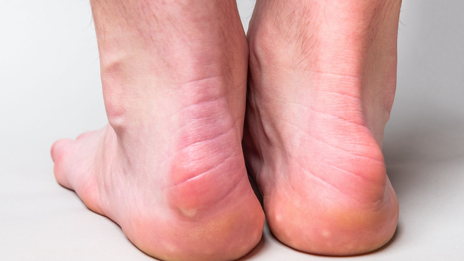Bump on the back of heel bone called Haglund's deformity on gray background.