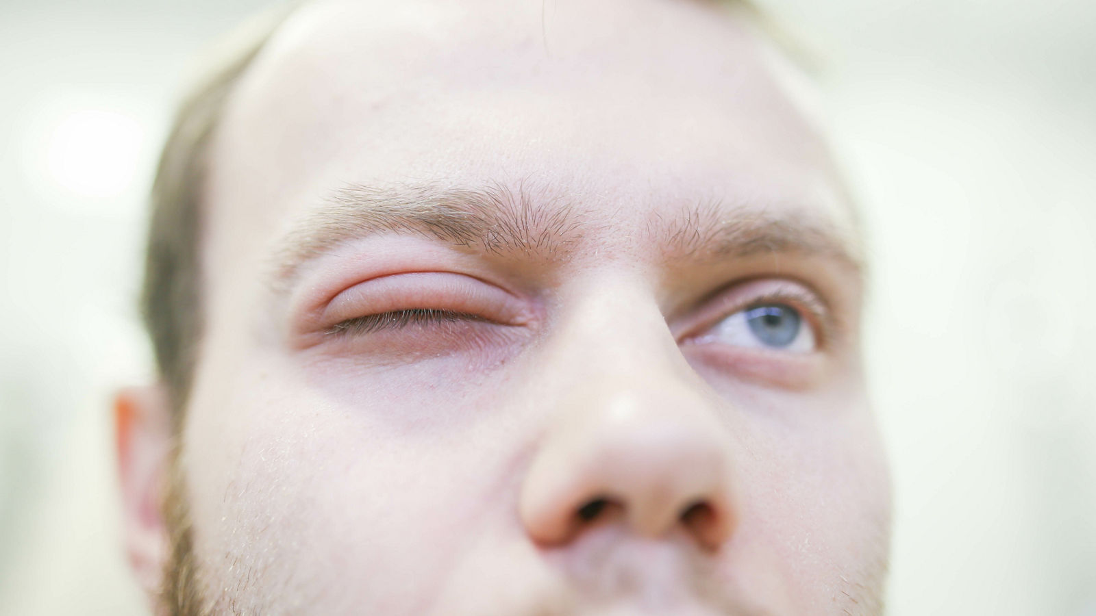 Allergic reaction to the eye of a young man. Angioedema