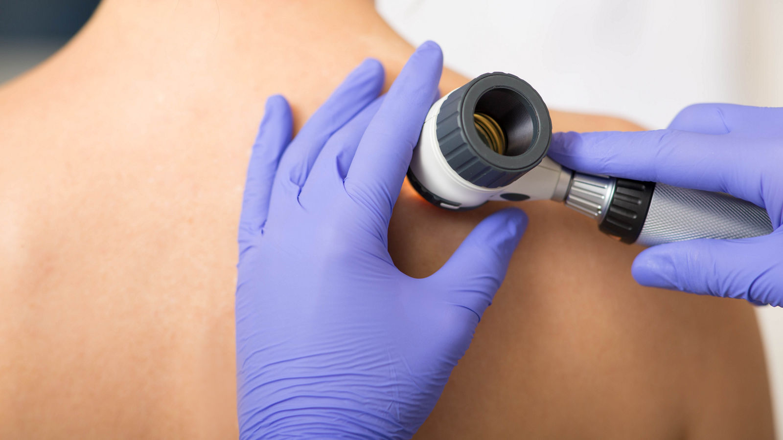 dermatologist Inspecting patient skin moles at clinic