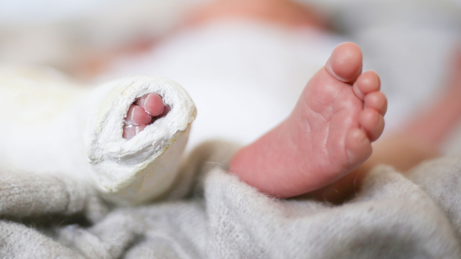 Closeup of newborn little baby with leg in a cast - clubfoot