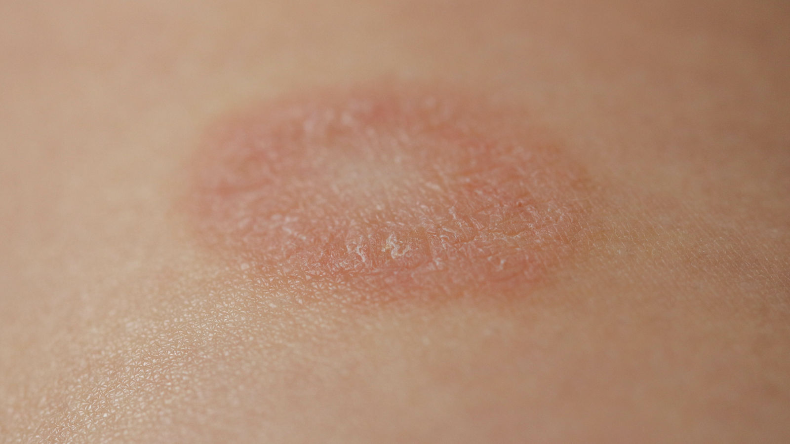 Pityriasis Rosea is a type of dermatitis with a mild pink or red skin rash and a flaky rash, maternal plaque, the first biggest papula. Gibera Syndrome.