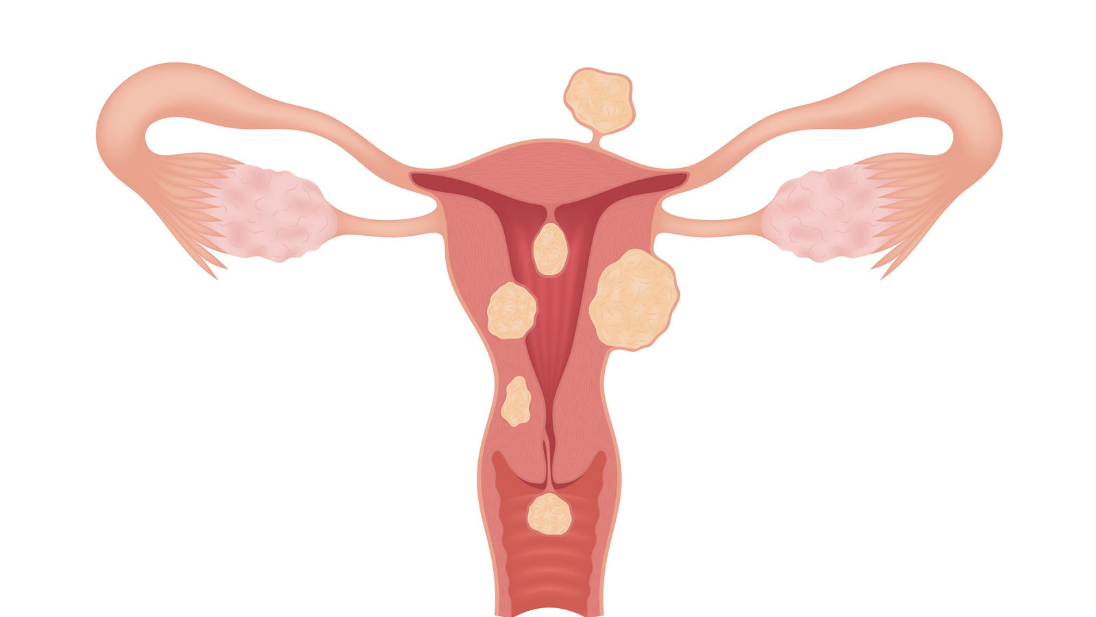 Sick female reproductive system with various types of myomas isolated on whte background. Realistic drawing showing the internal organs. Frontal view in a cut.