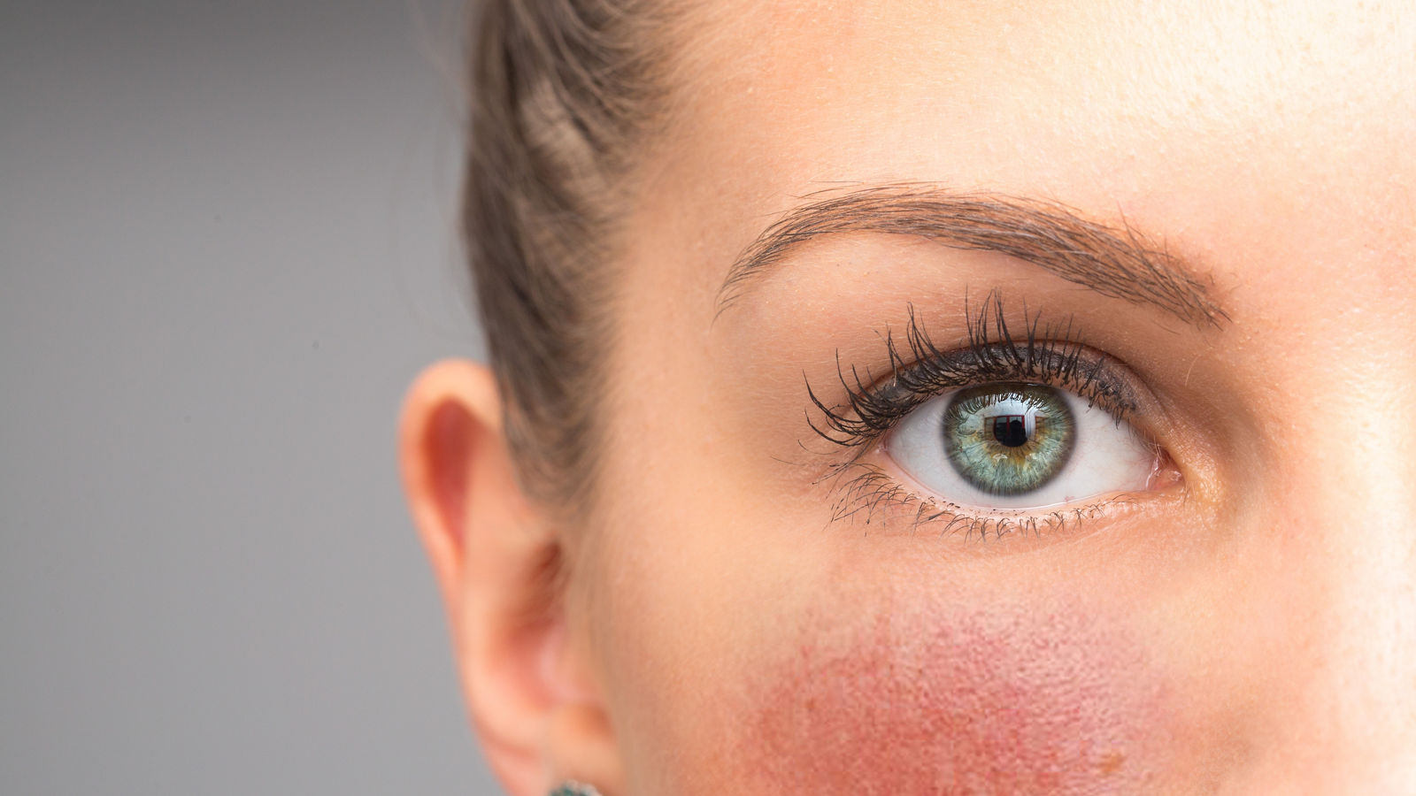 Red flushing cheeks are seen closeup, in the face of a stunning thirty something caucasian girl, permanent redness and small visible blood vessels, symptoms of rosacea with room for copy.