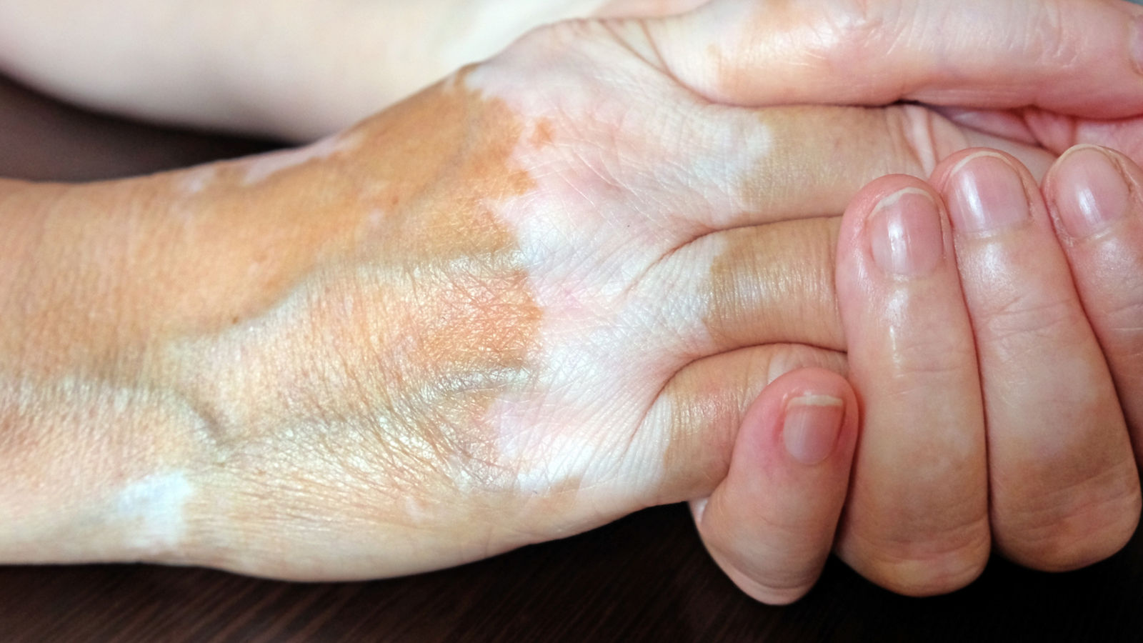 Woman's hands folded. The skin is stained with vitiligo. Vitiligo on the hands of a woman aged.