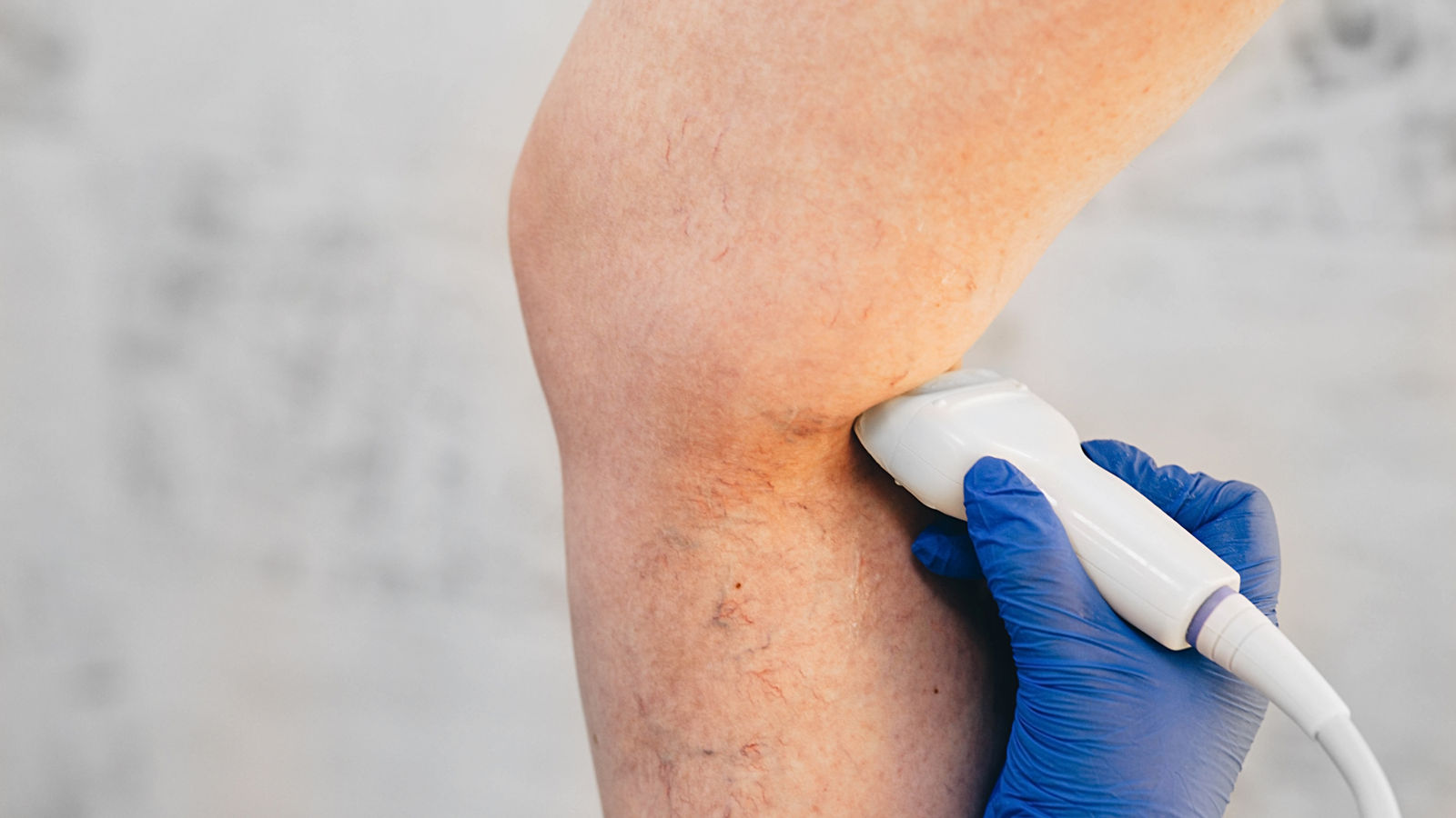 cropped ultrasound exam veins on the leg, vein thrombosis, varicose veins