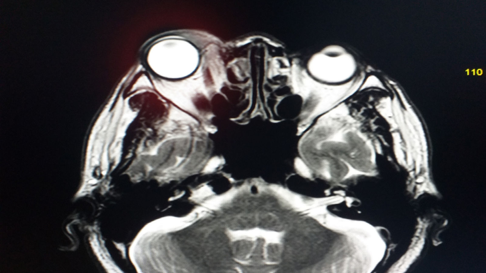 MRI Brain and Orbits Showing mass.