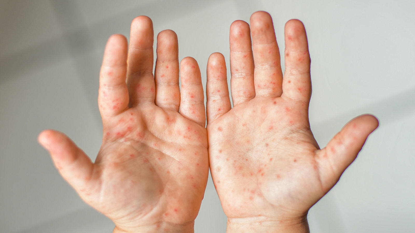 Enterovirus Leg arm mouth Rash on the body of a child Cocksackie virus