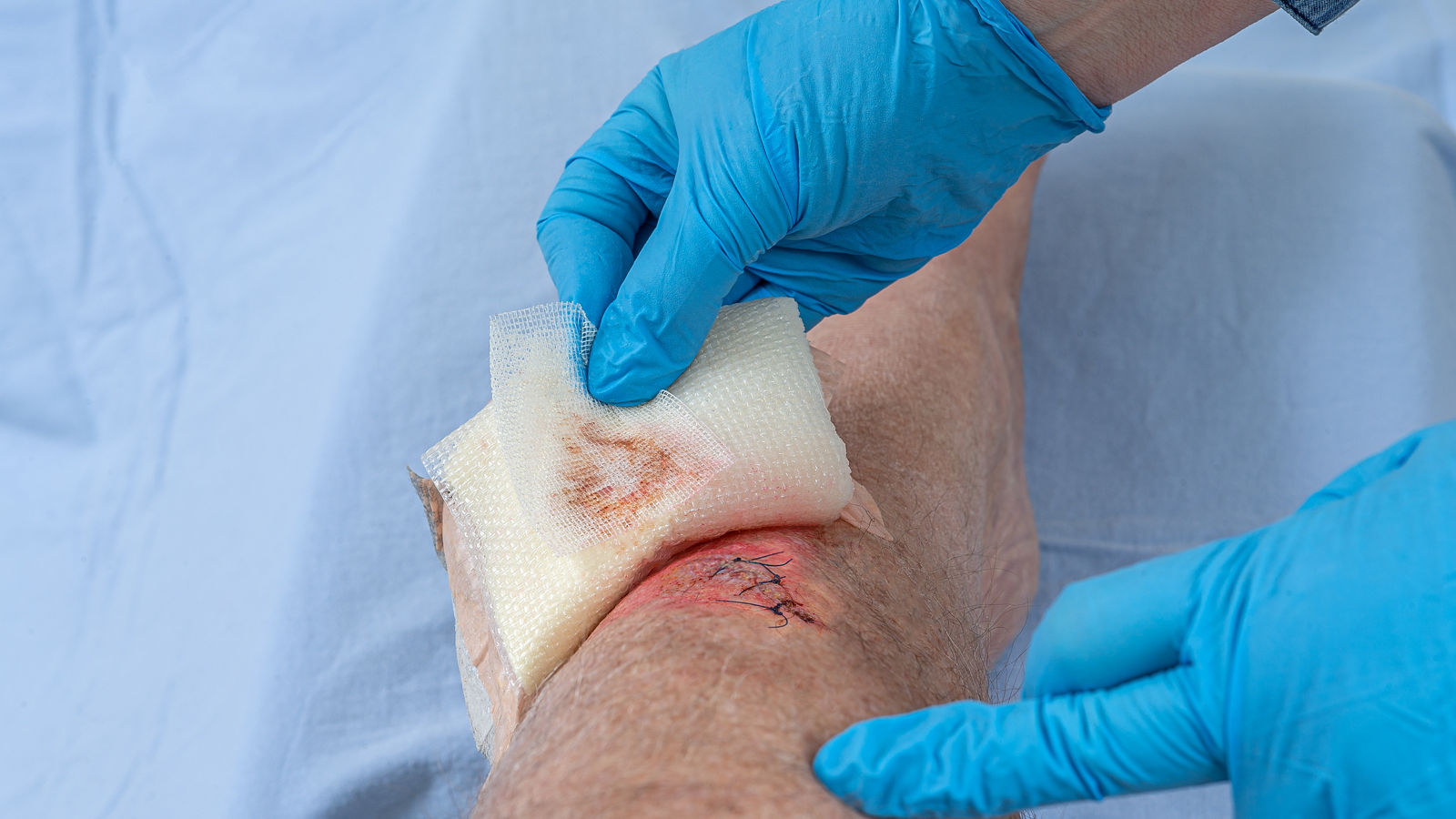 Nurse caring fresh blooded injury wound on the tibial bone of the leg. Sticking stitches to hold the cut.