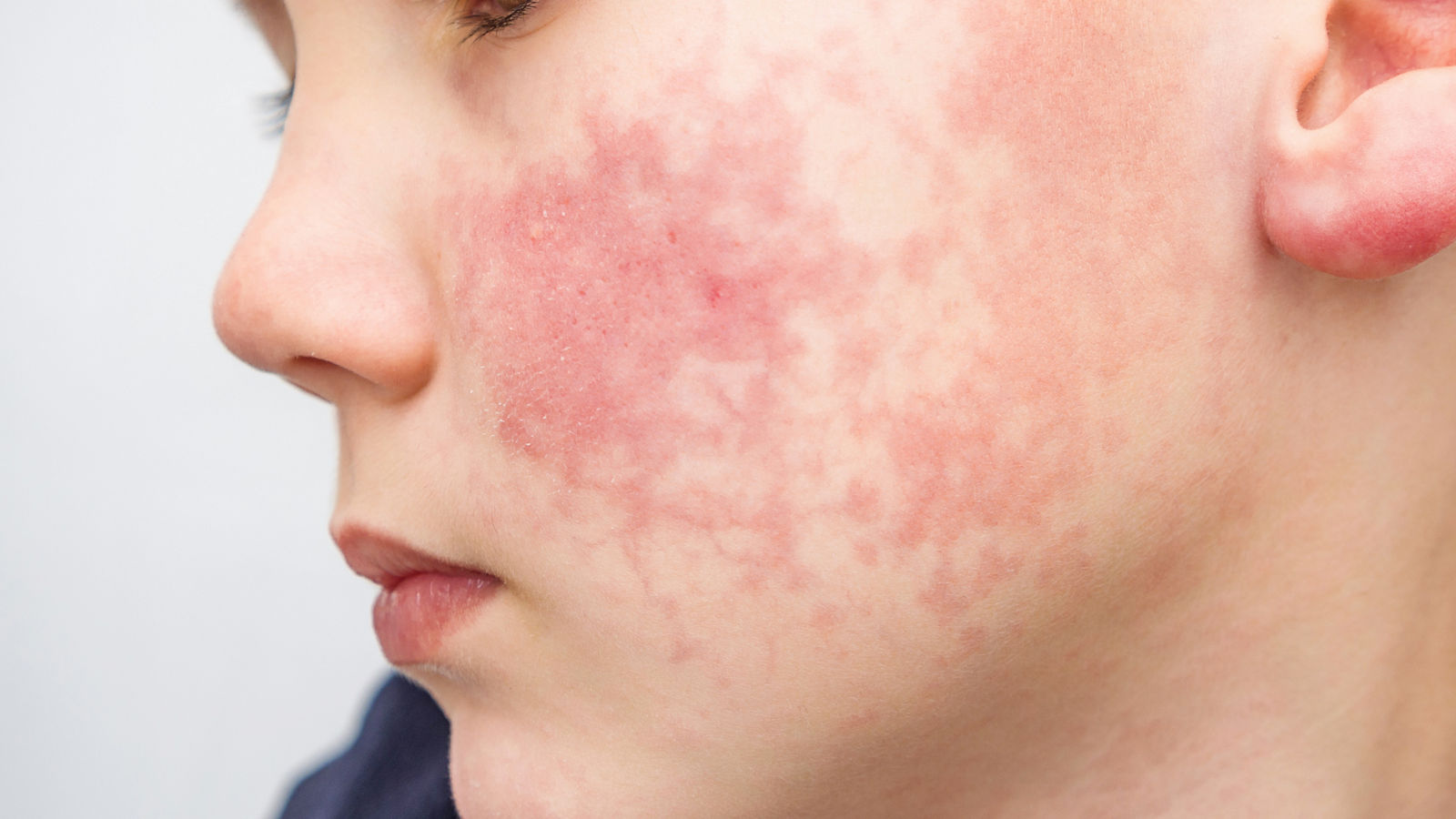 Boy with red cheeks- diathesis or allergy symptoms. Redness and peeling of the skin on the face. 