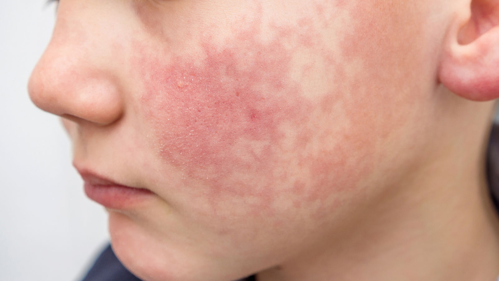 Boy with rosy red cheeks- diathesis, enterovirus infection or allergy symptoms. Redness and peeling of the skin on the face. 
