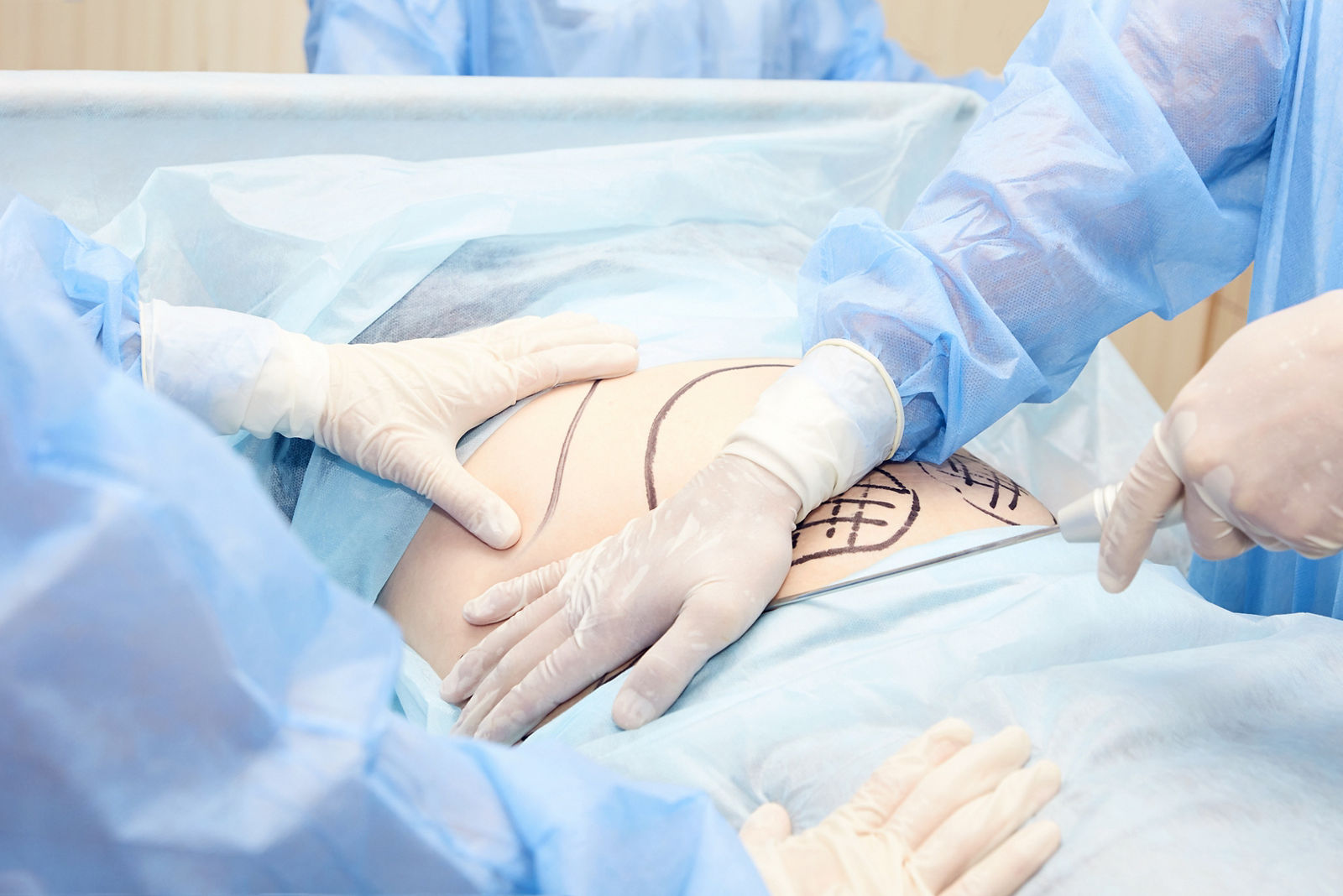 Surgery room. Belly surgery. Doctor mark liposuction area at tummy. Drawing at skin. Anti cellulite equipment. Copy space. Light blue color. Fat abdomen. Hostipal doctor hands