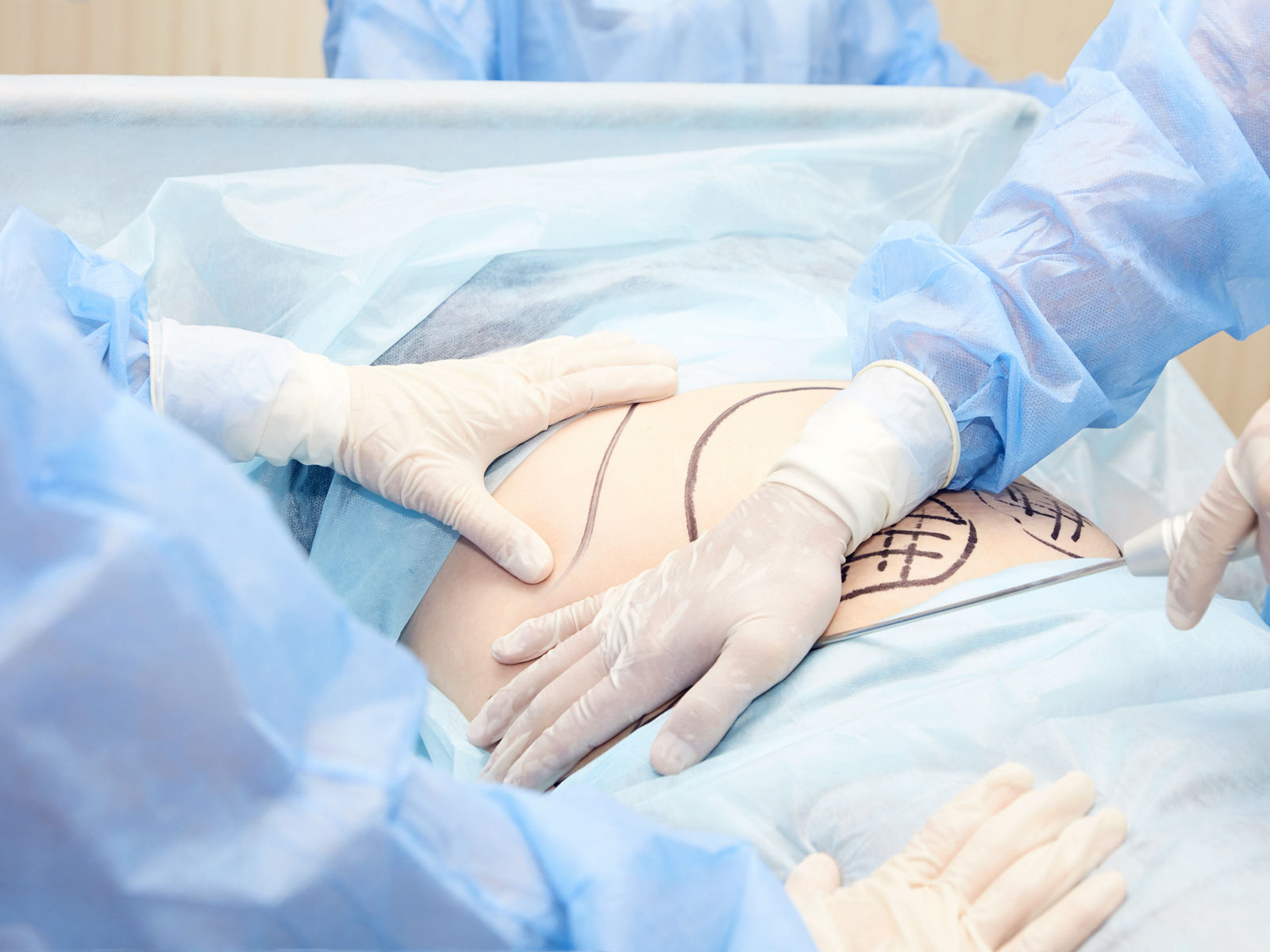 Liposuktion bei Lipödem: Voraussetzungen, Ablauf und Kostenübernahme