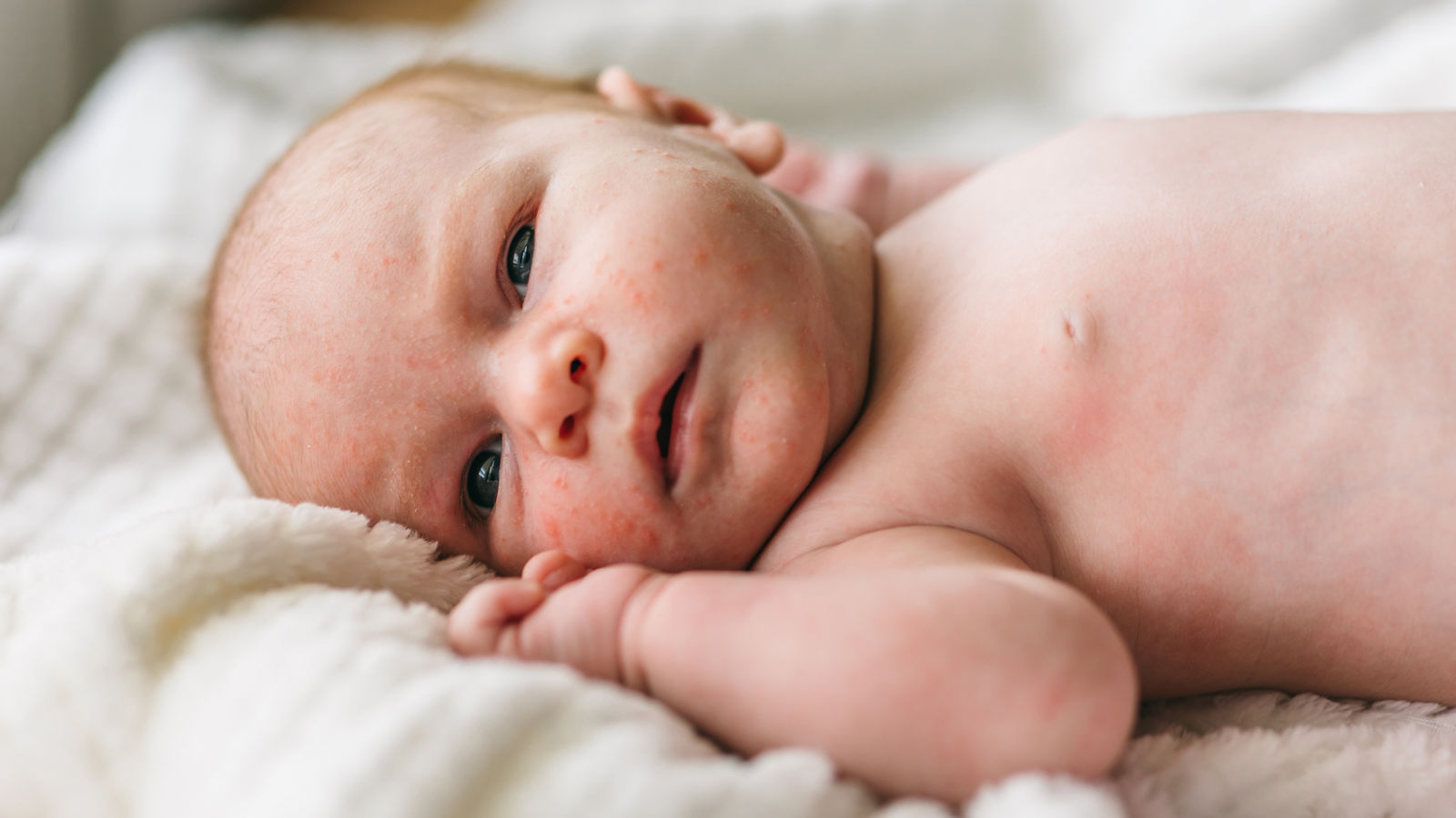 Baby acne, small red and purulent inflammations on the skin of the face of a one-month-old baby. How to distinguish from atopic dermatitis, allergies,Baby acne, small red and purulent inflammations on the skin of t